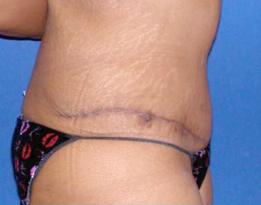 Abdominoplasty / Tummy Tuck - Dr. Wendell Miles